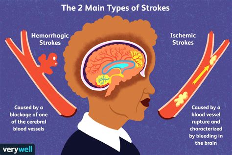 What Causes a Stroke - calories, carbs, nutrition